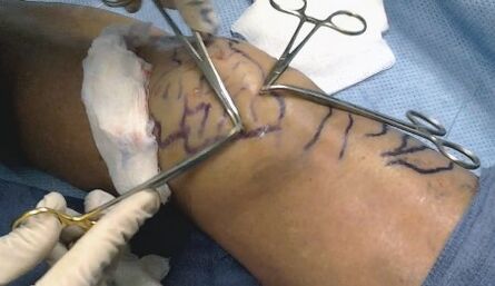 Cirugía varicocele