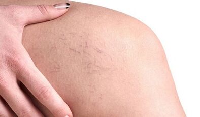 Cómo se manifiestan las venas varicosas en las mujeres