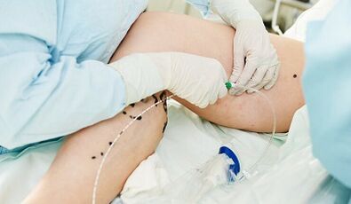 Tratamiento de las venas varicosas en las piernas de las mujeres