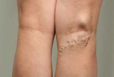 Diagnóstico de varices en mujeres embarazadas.