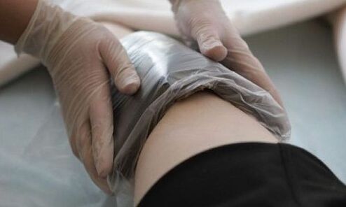 Compresas para tratar las varices