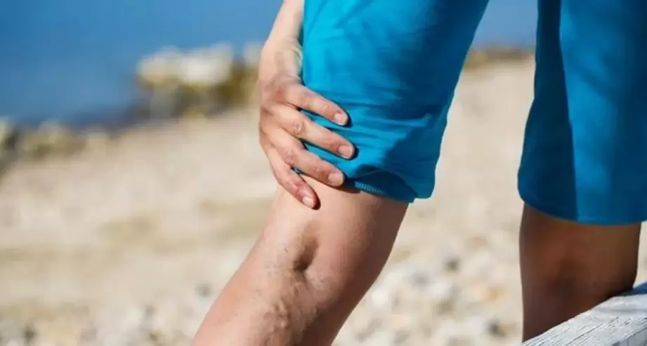 Venas varicosas en las piernas