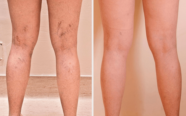 Piernas antes y después del tratamiento de varices