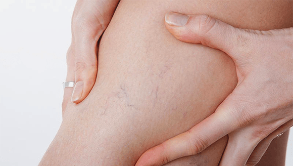 Venas varicosas en las piernas