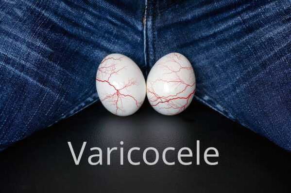 Varicocele dilatación de las venas espermáticas.