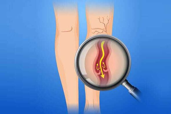 Válvulas venosas afectadas por venas varicosas